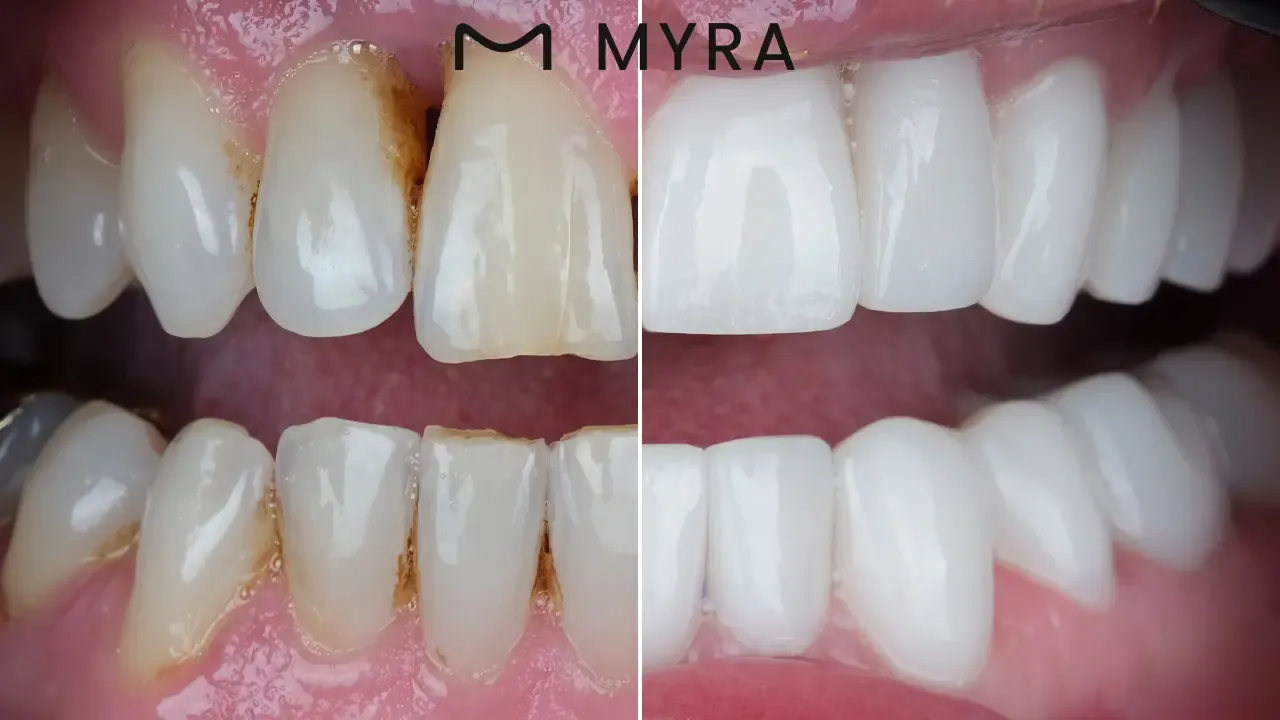 enamel shaping - definition, advantage, and cost