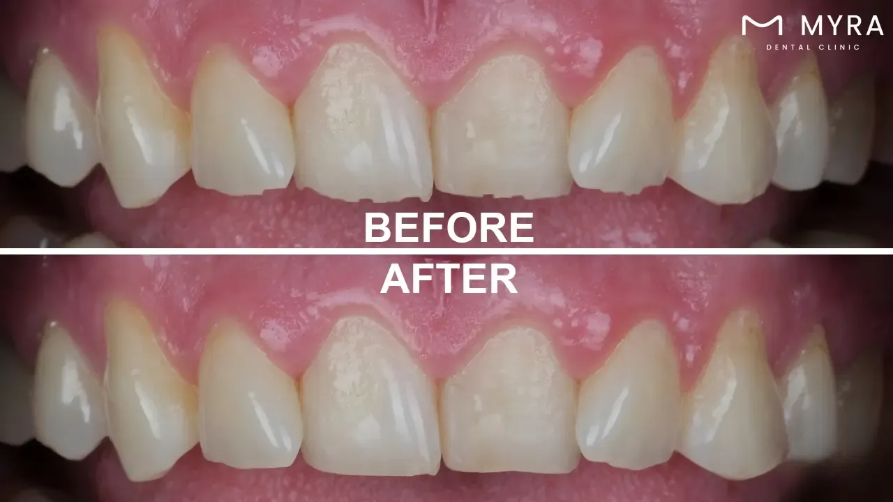 Enamel shaping in smile design