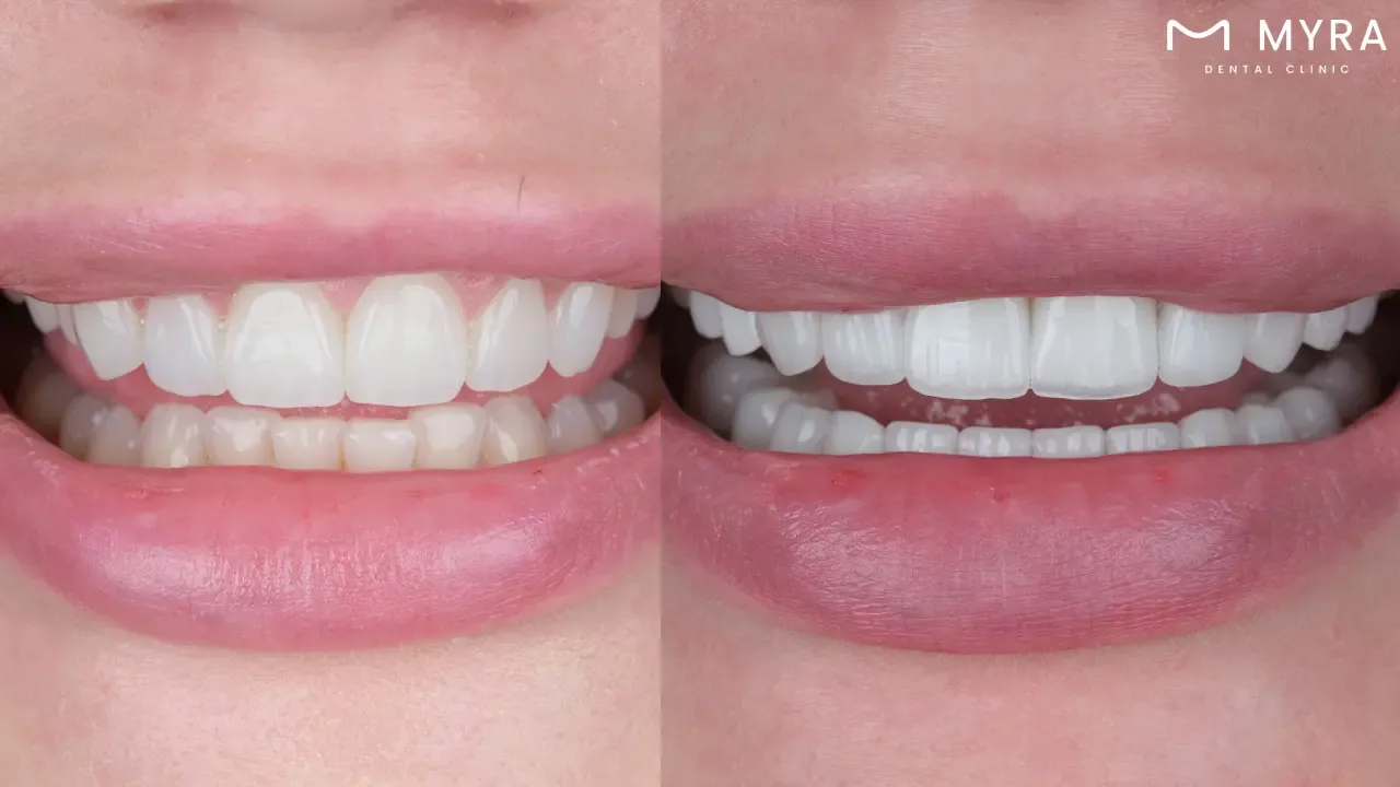Exploring veneer teeth: A comprehensive guide