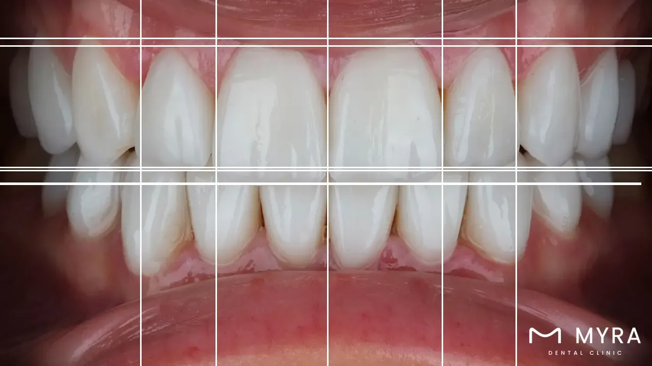 Facial esthetics in dentistry: Definition and different procedures