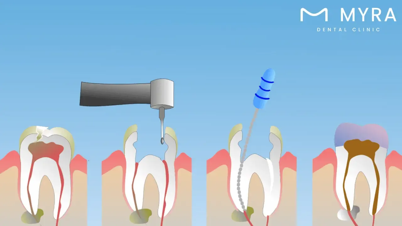 Filling the canals with gutta-percha