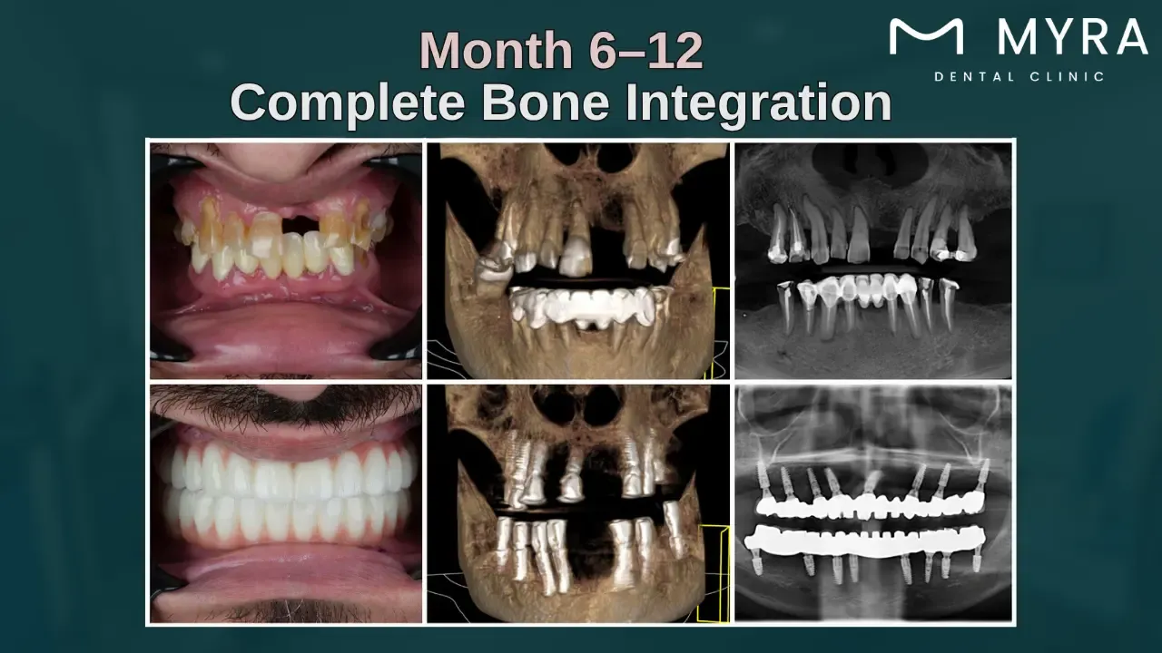 full bone integration of dental graft