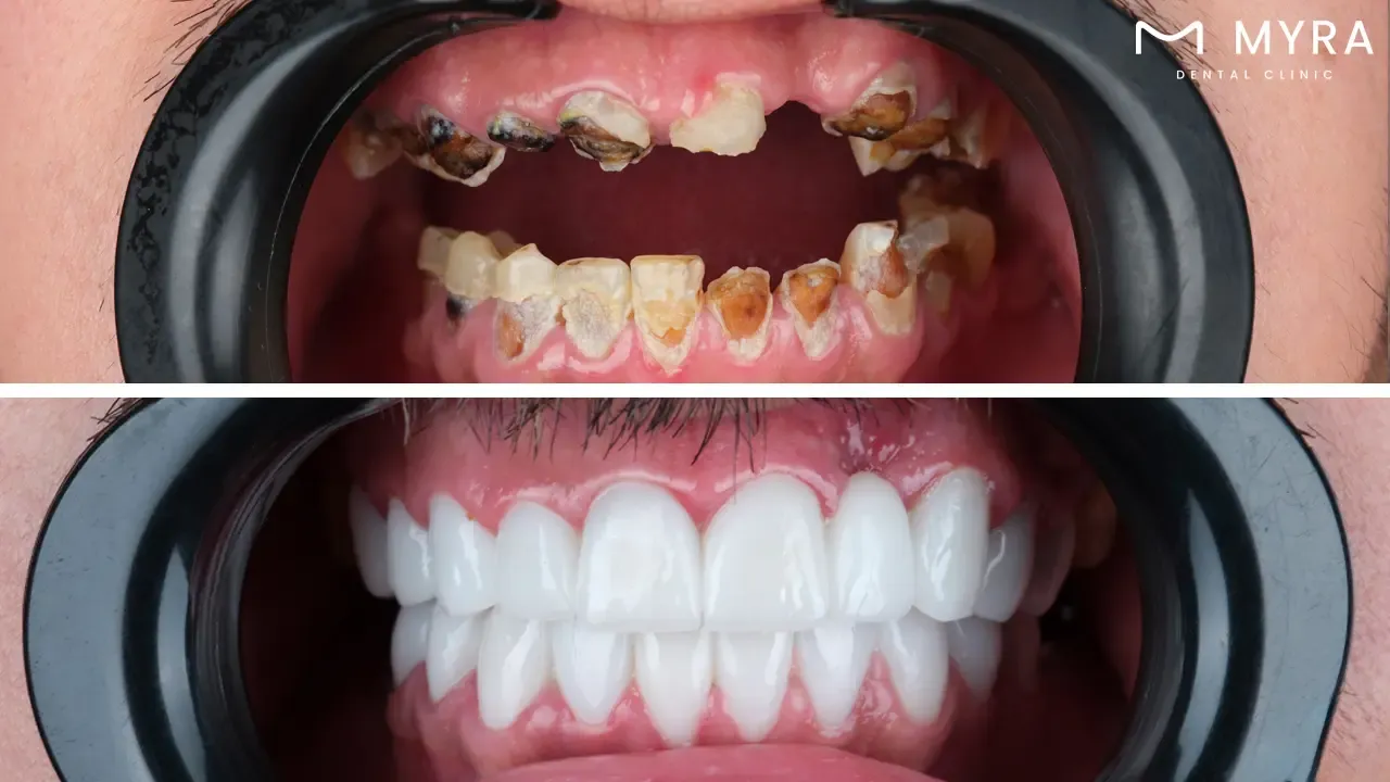 Full mouth rehabilitation in turkey