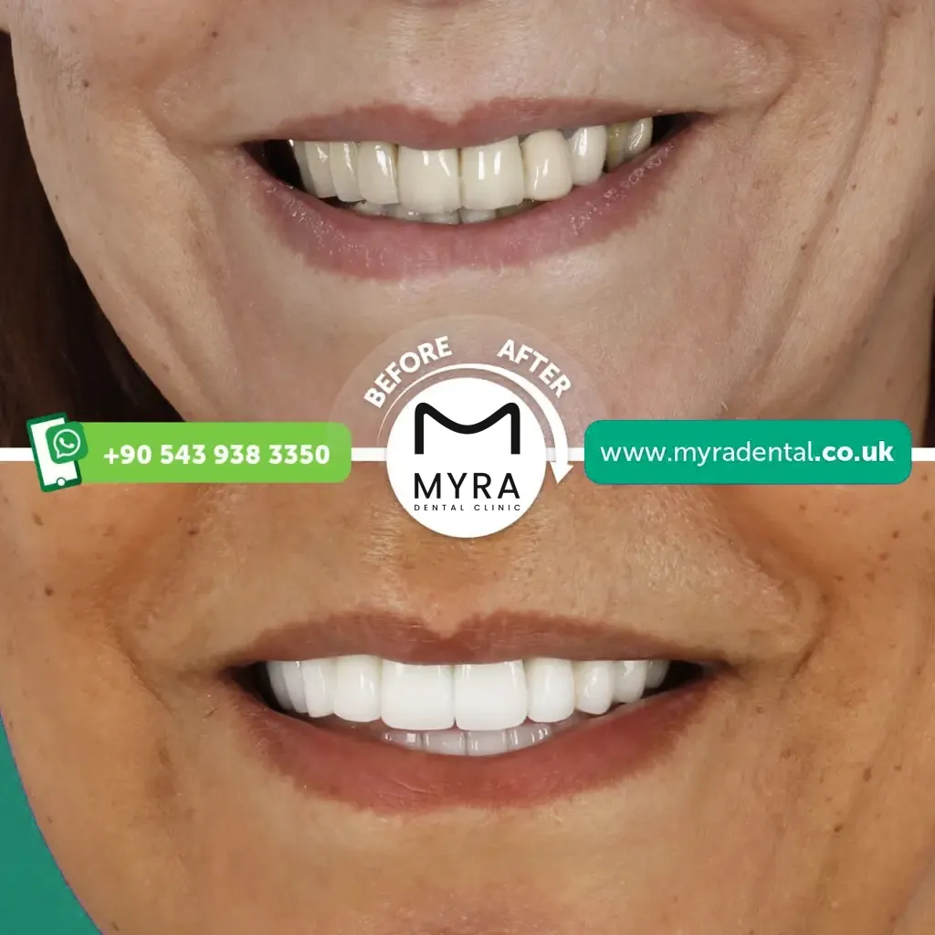 Full set of veneers in turkey