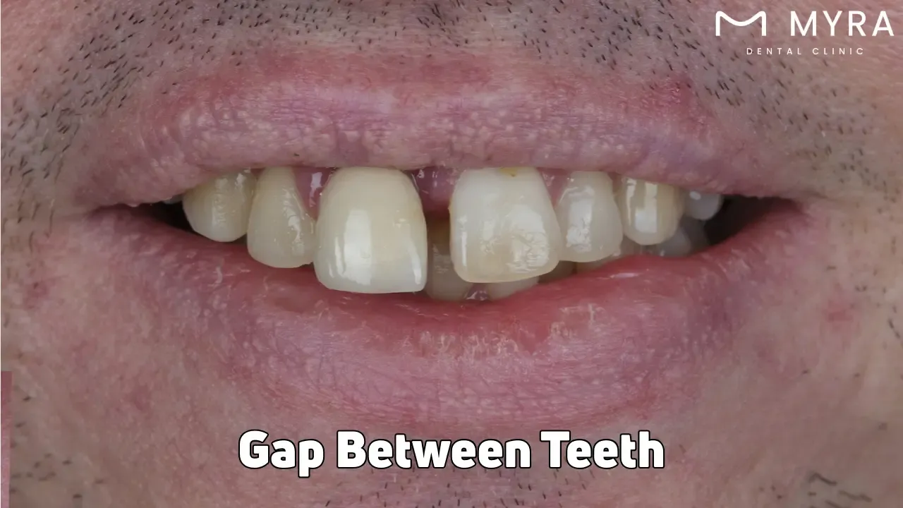 Gap between teeth