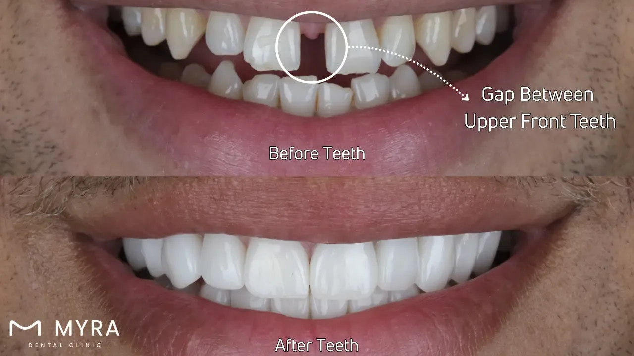 Gap between teeth: Symptoms, treatment, and causes