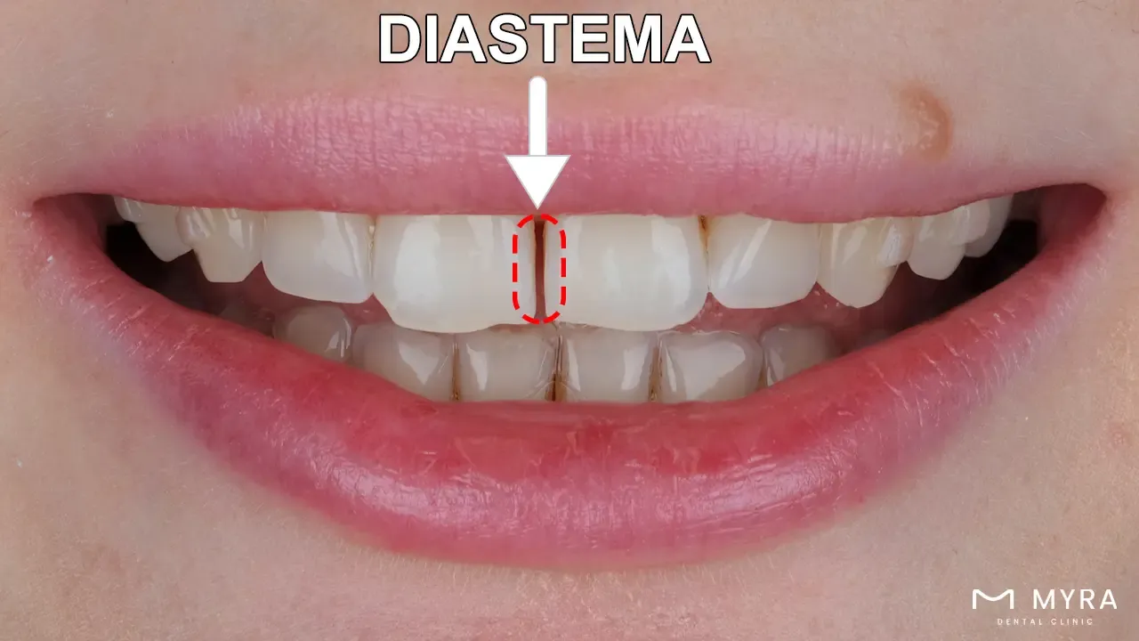 Gaps or diastema