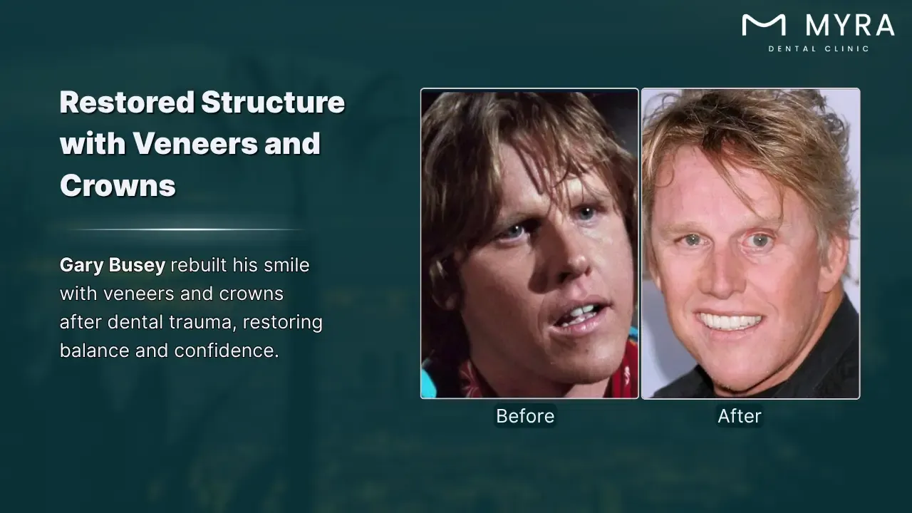 gary busey's dental work