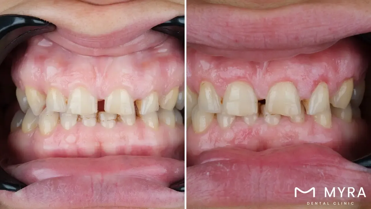 Gingival esthetics: Definition, different procedures, advantages, and disadvantages