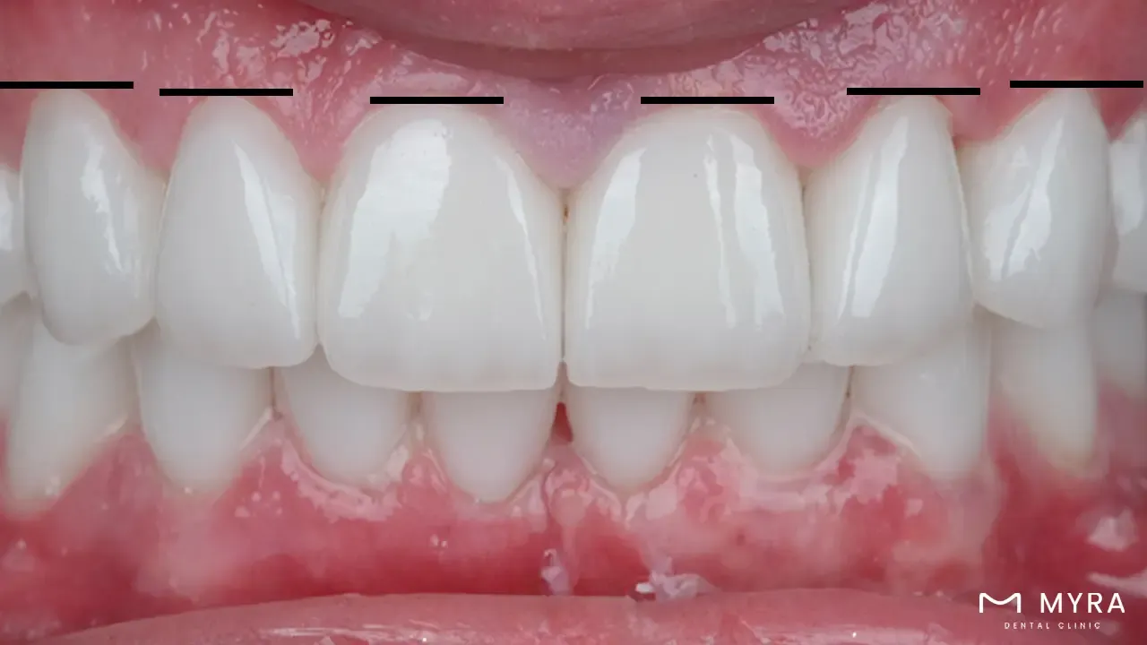 Gingival Margins