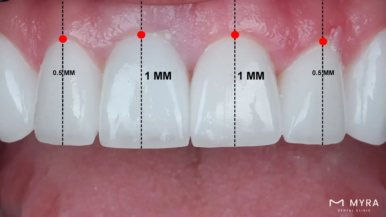 Gingival zenith