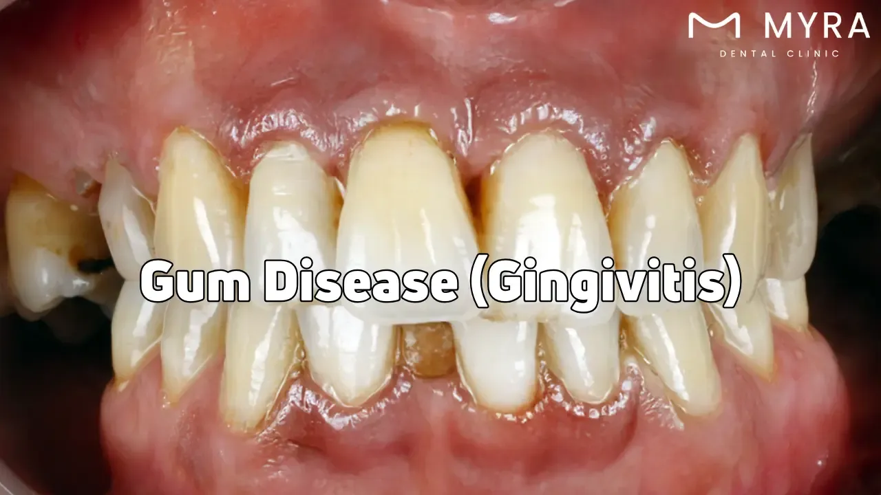 Gum disease treatments and type of infection in gums