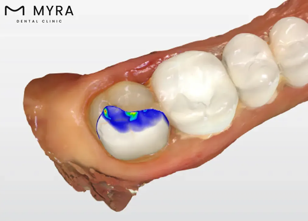 glass-ionomer-fillings.webp