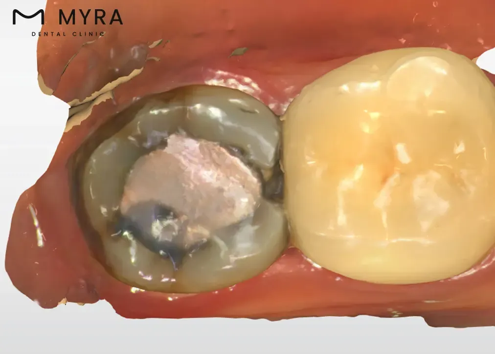 gold-fillings.webp