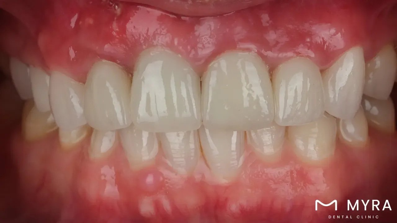 Gum contouring