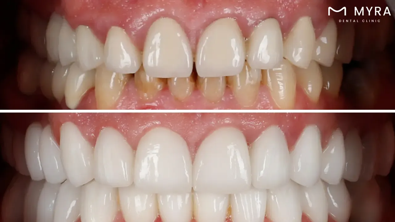 Gum contouring for smile design