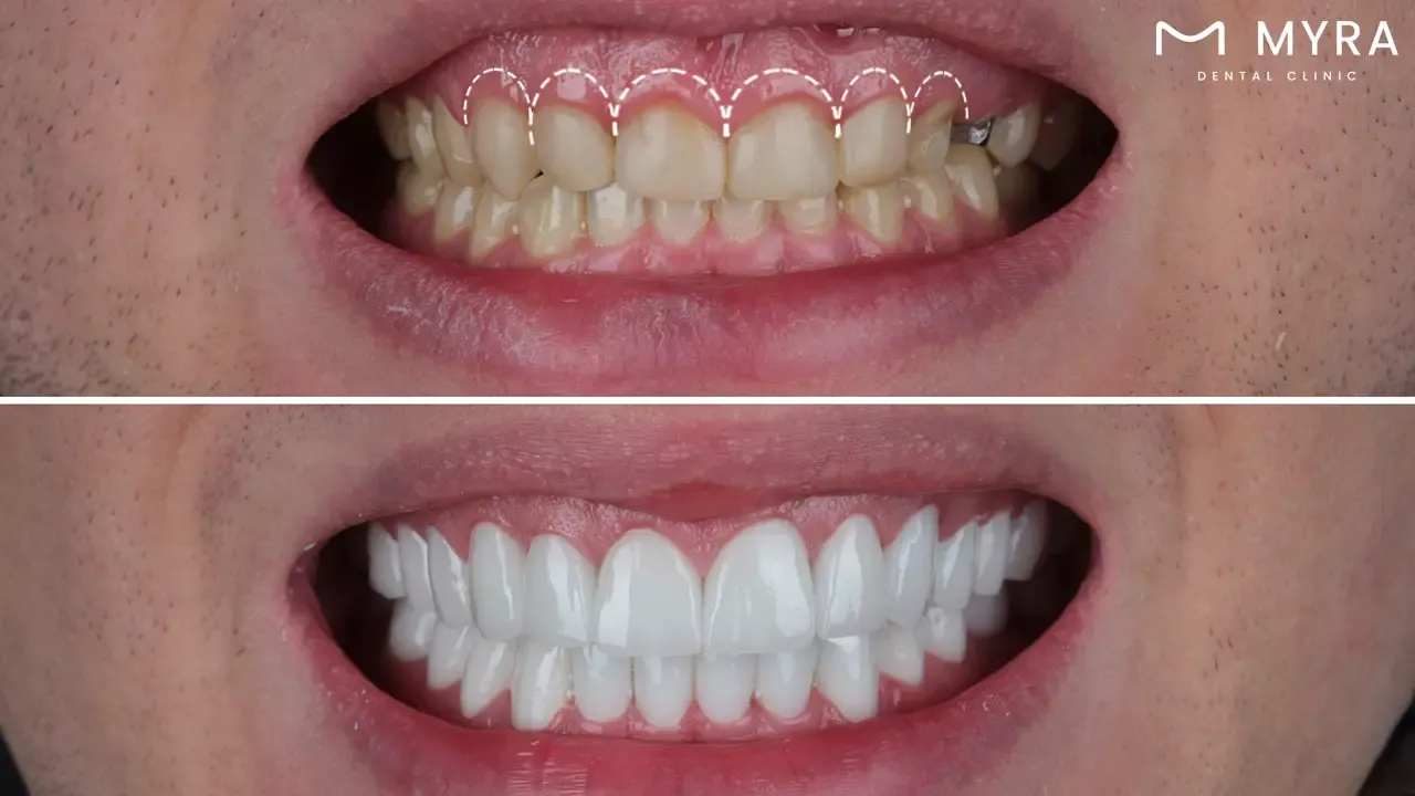 Gum contouring in turkey