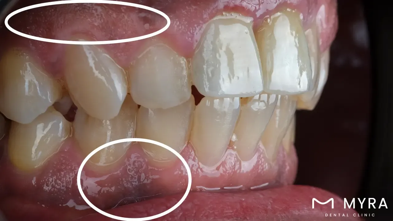 Gum depigmentation
