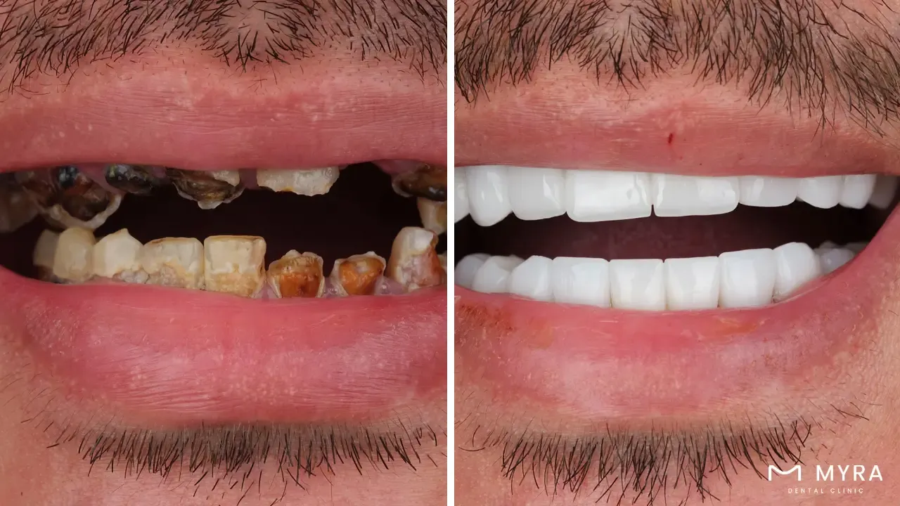 Gum disease and bad breath