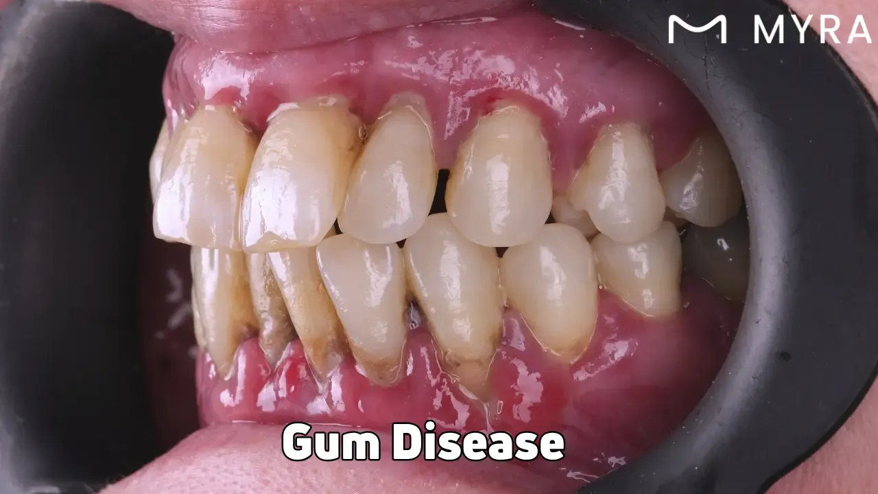 Gum disease: Symptoms, treatment, and causes
