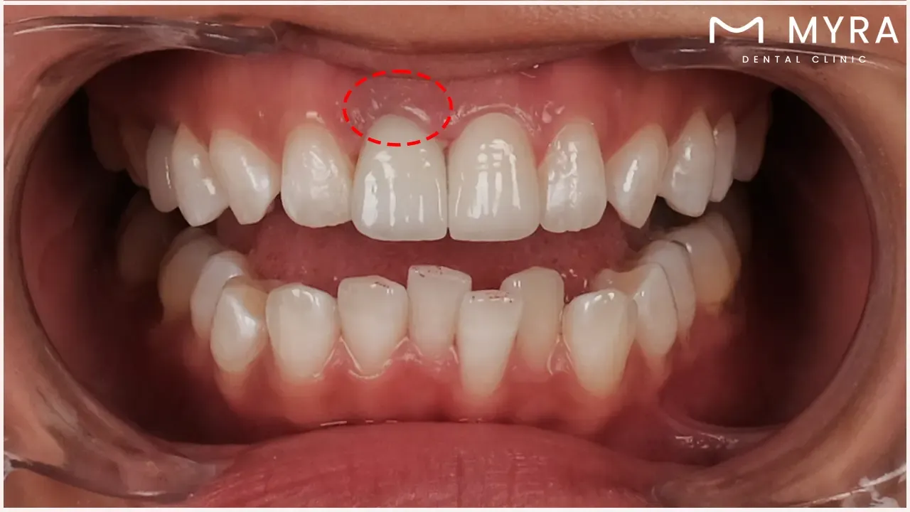 Gum irritation from teeth whitening