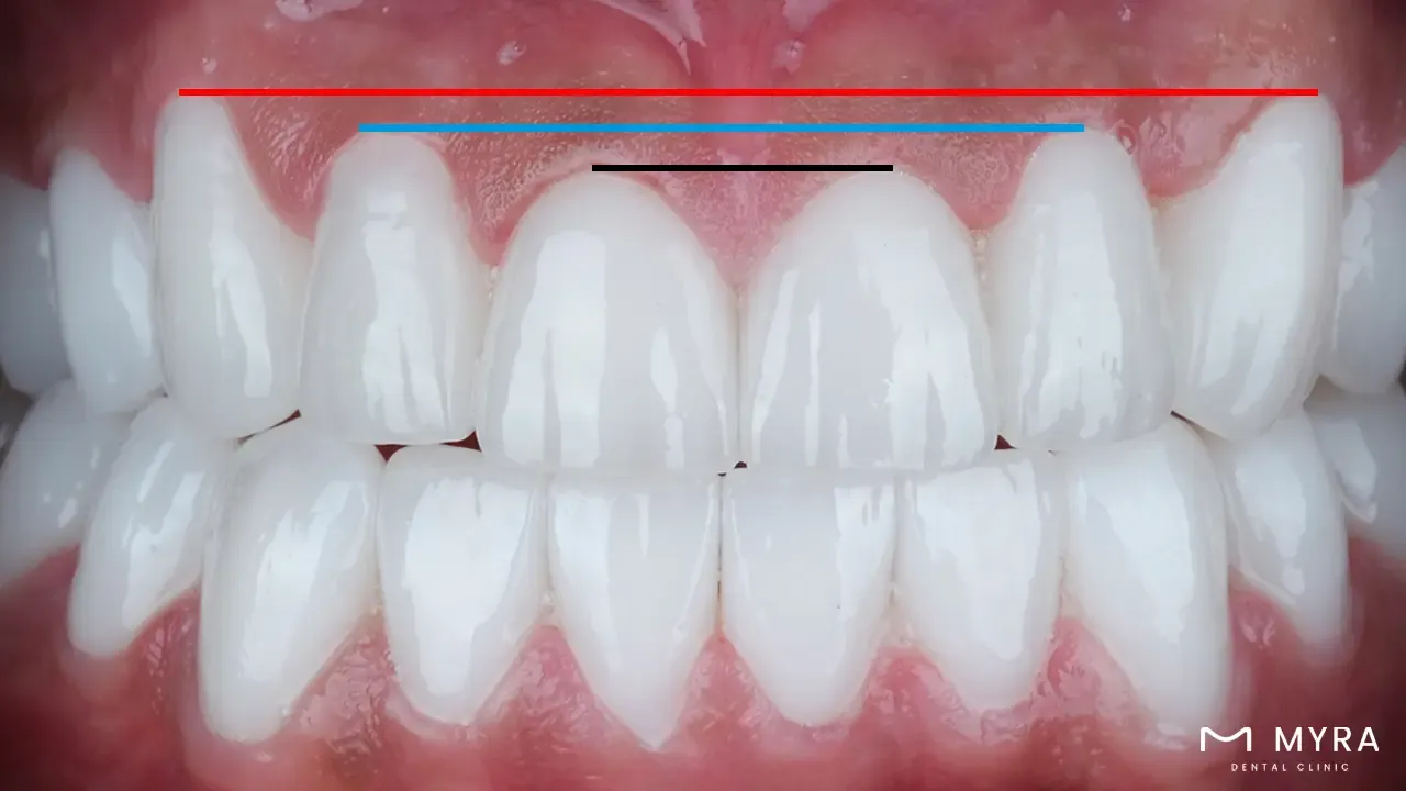 Gum line symmetry and balance