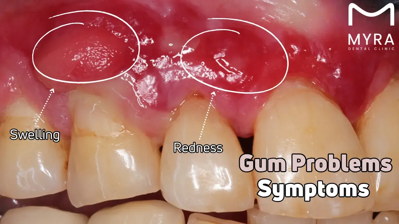 Gum problems: Symptoms, treatment, and causes