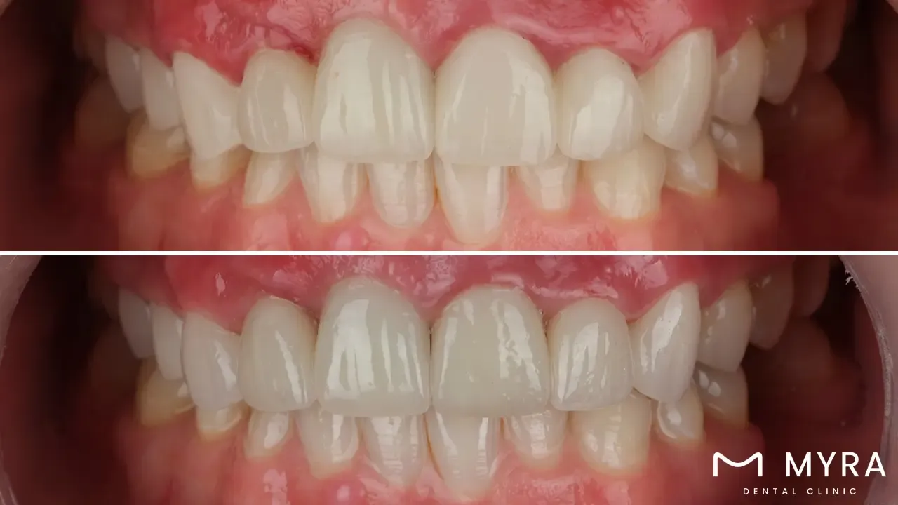Healing time for gingival esthetics