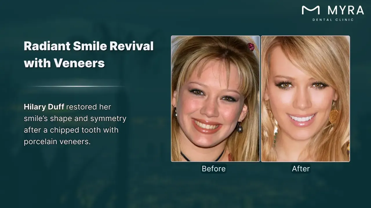 hilary duff's veneer story