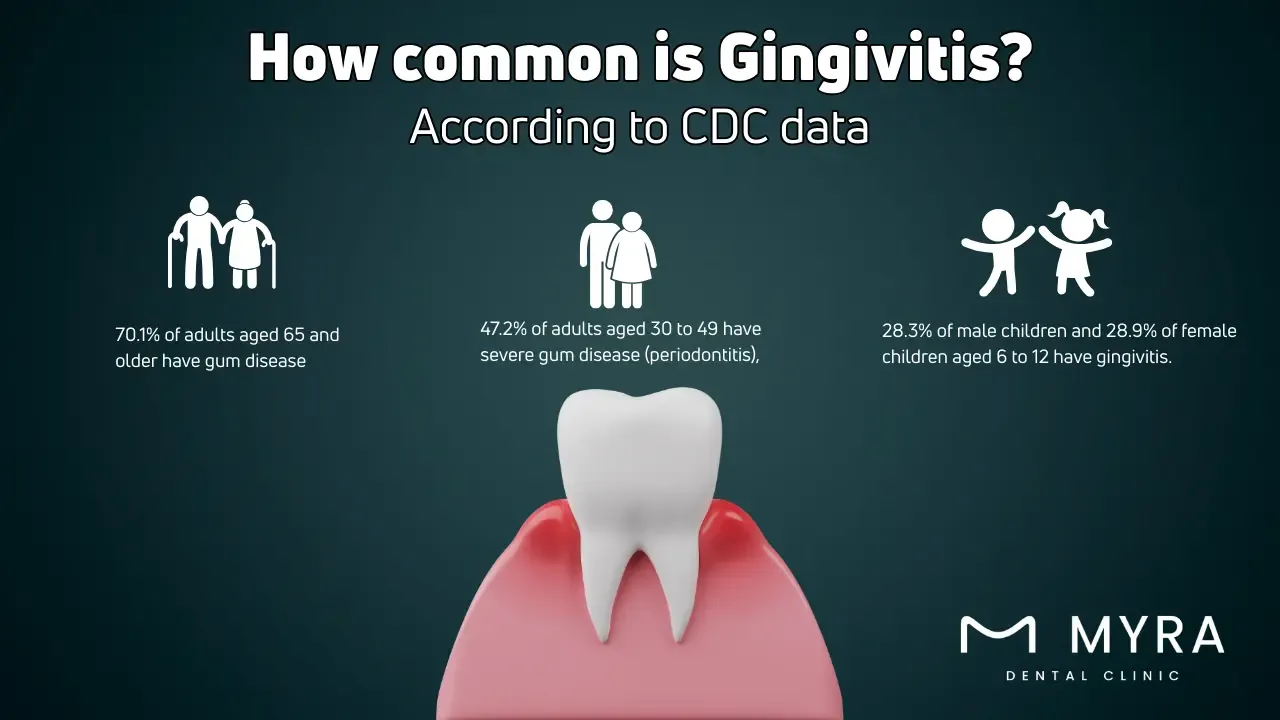 How common is gingivitis?