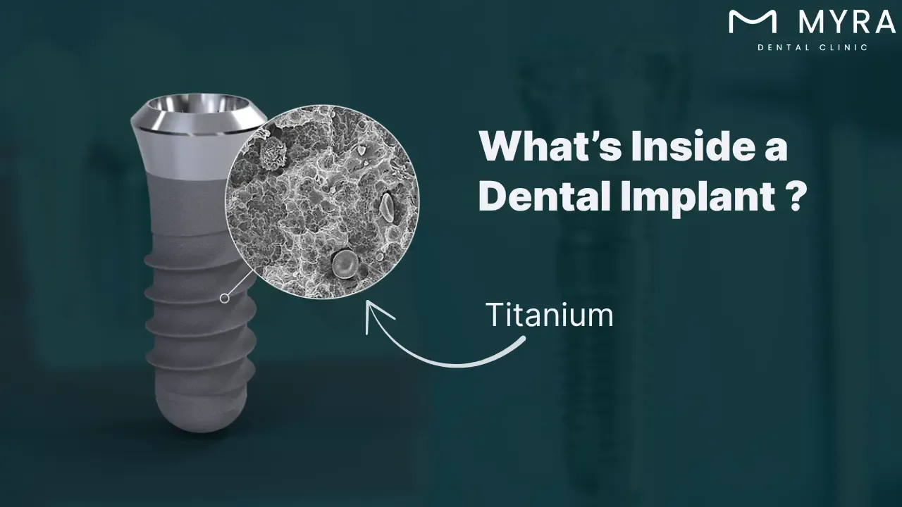 how do dental implants work?