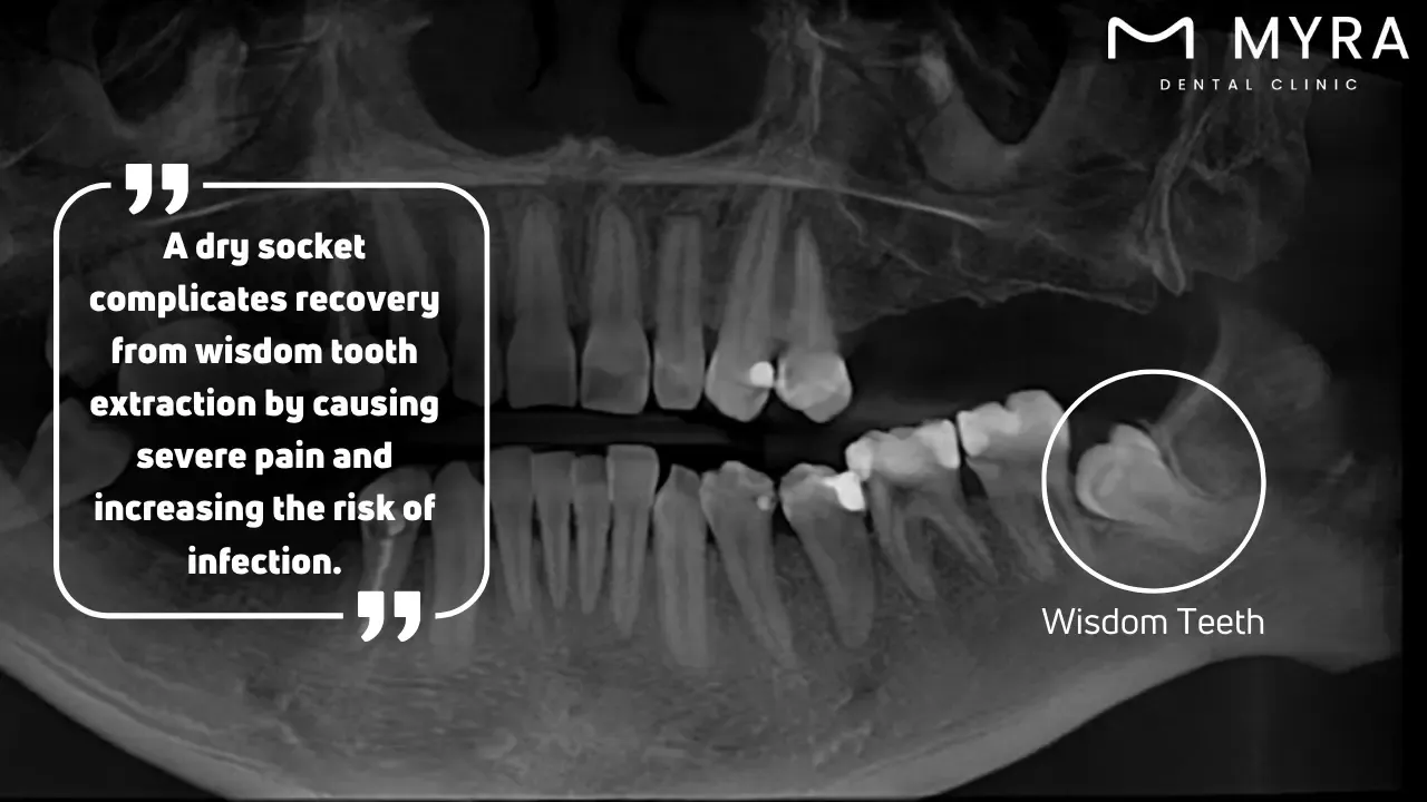 How does dry socket affect a wisdom tooth extraction site?