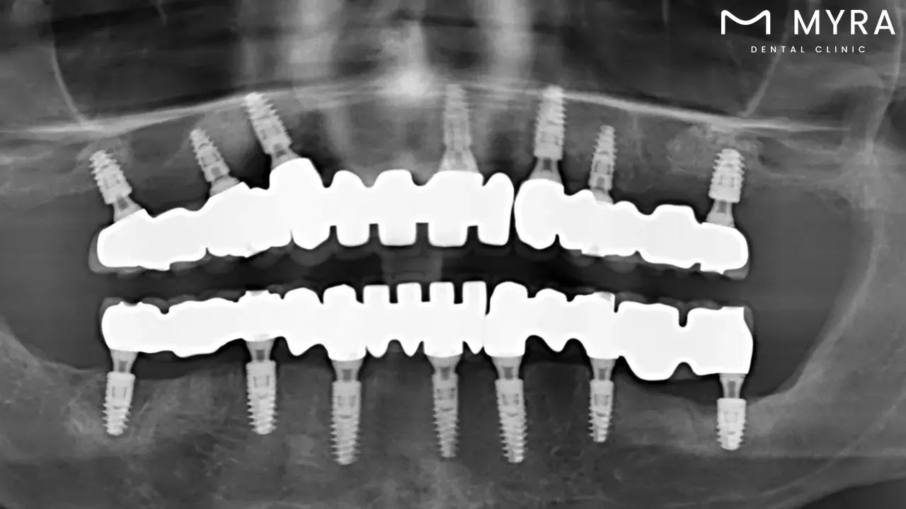 how do i take care of overdenture implants?