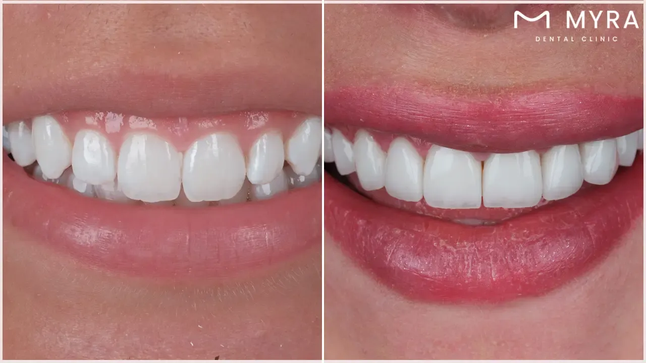 How do teeth whitening and dental laminates differ in the process?