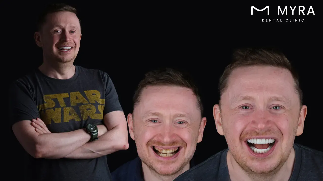 How do the quality of veneers differ between the uk and turkey