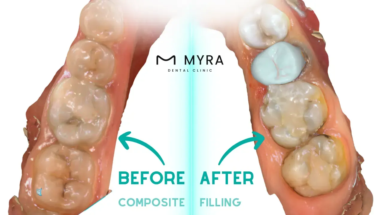 How does a dental filling look before and after in turkey?