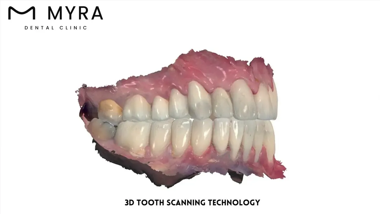 How does advanced technology and equipment in india and turkey affect veneer procedures