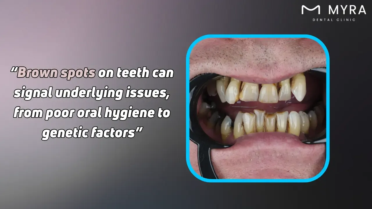 How do brown spots on teeth develop?