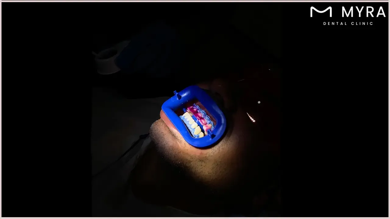 How does teeth whitening work?