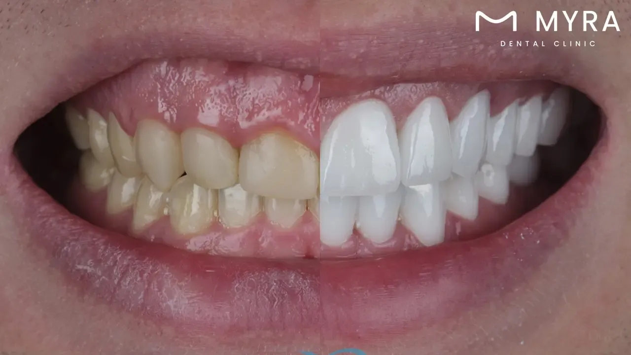 How does the maxillary central incisor position affect gummy smiles?