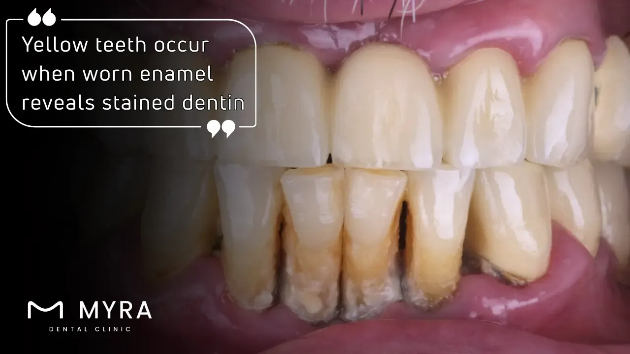 How do yellow teeth develop?