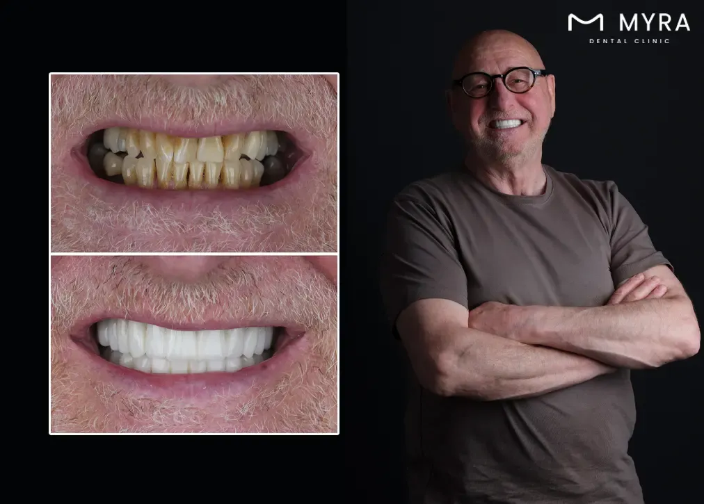 How durable is emax dental crown