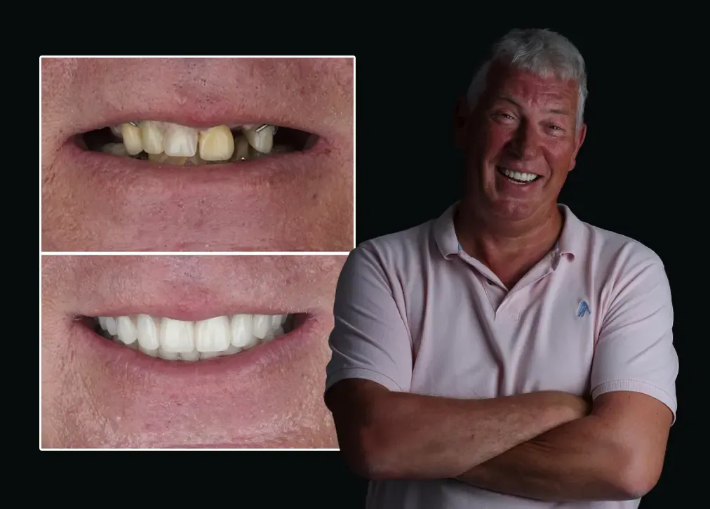 How is a root canal treatment in turkey done?