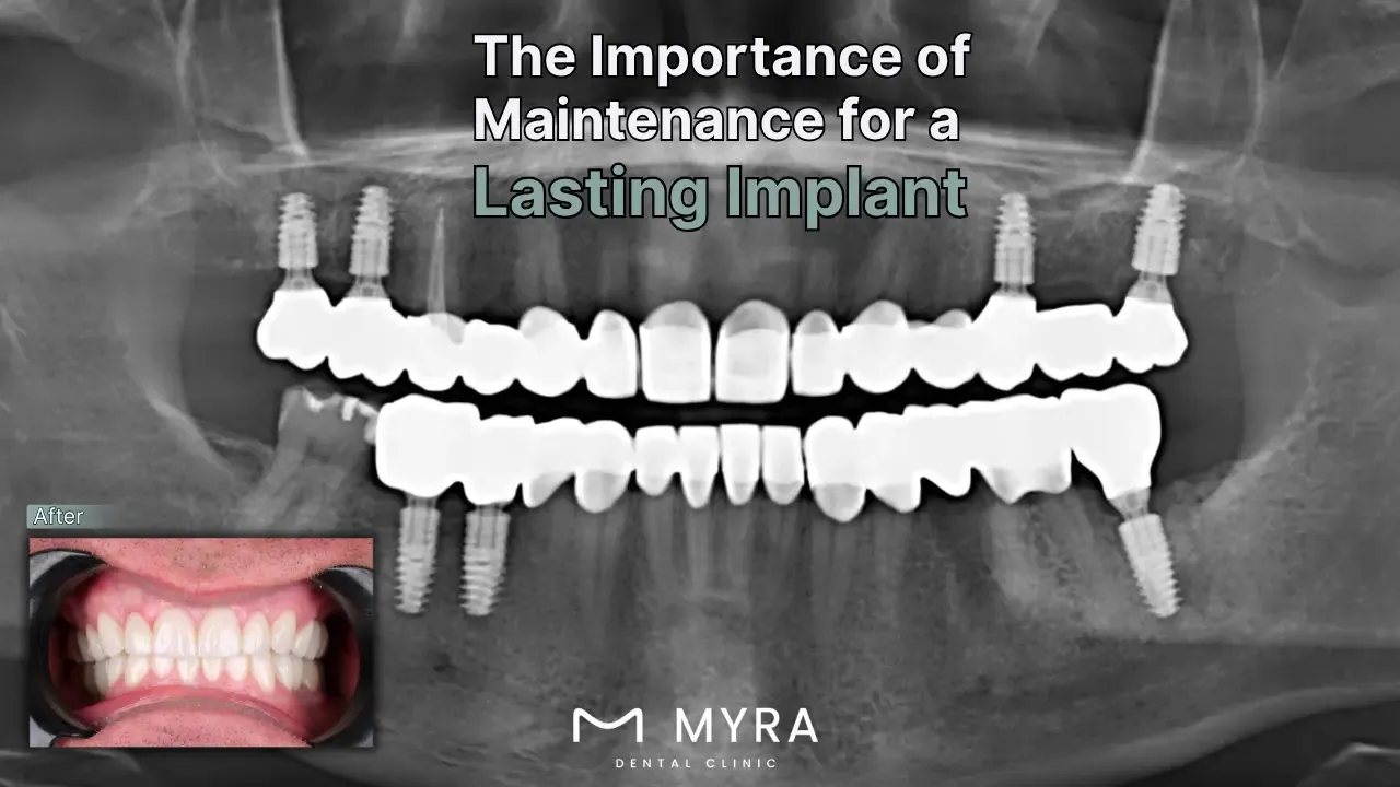 how is dental implant maintenance done?
