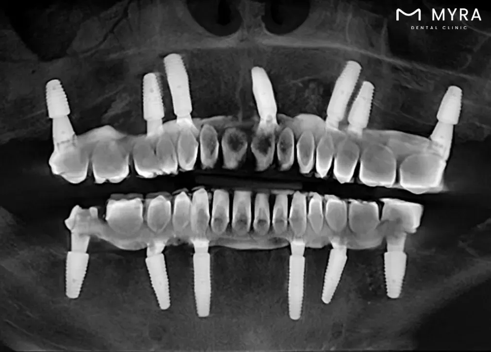 How is sirona 3d dental tomography different from traditional dental x-rays?