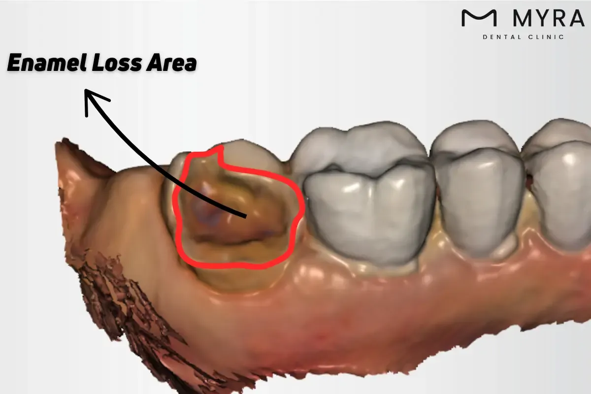 How is the placement of an onlay carried out?