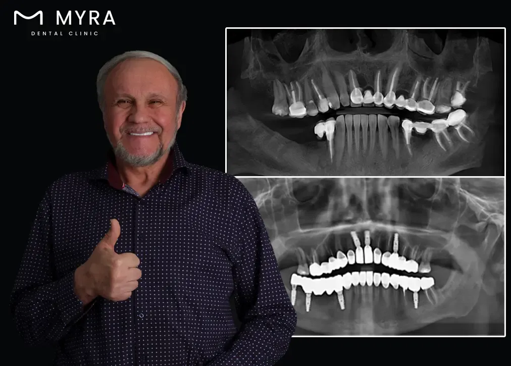 How is tooth extraction in turkey treatment done?