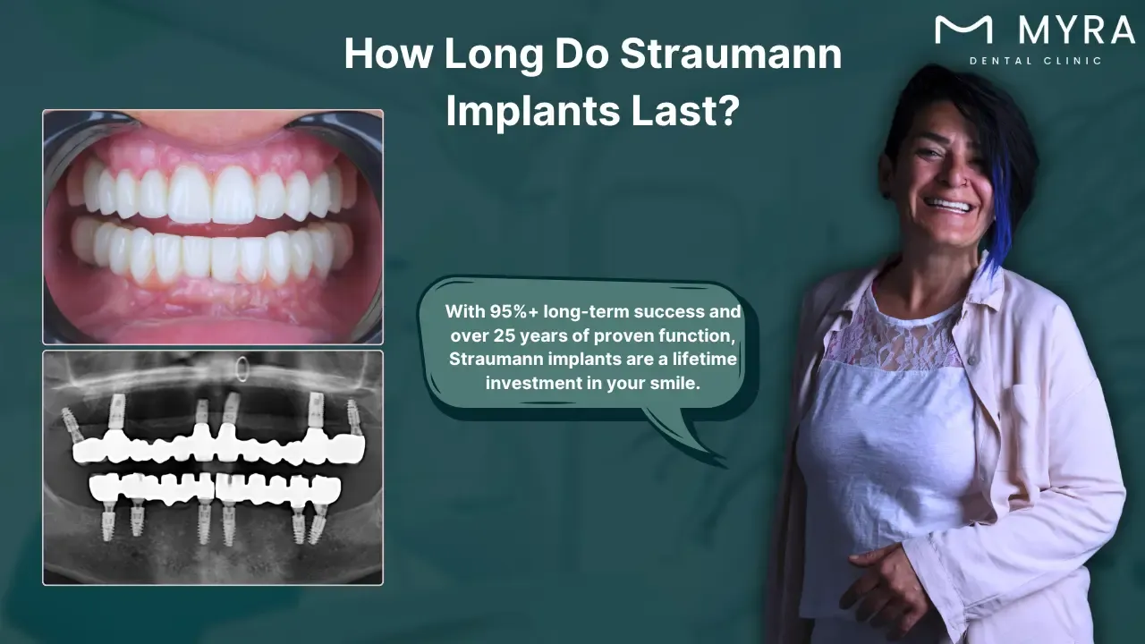 how-long-do-straumann-implants-last.webp