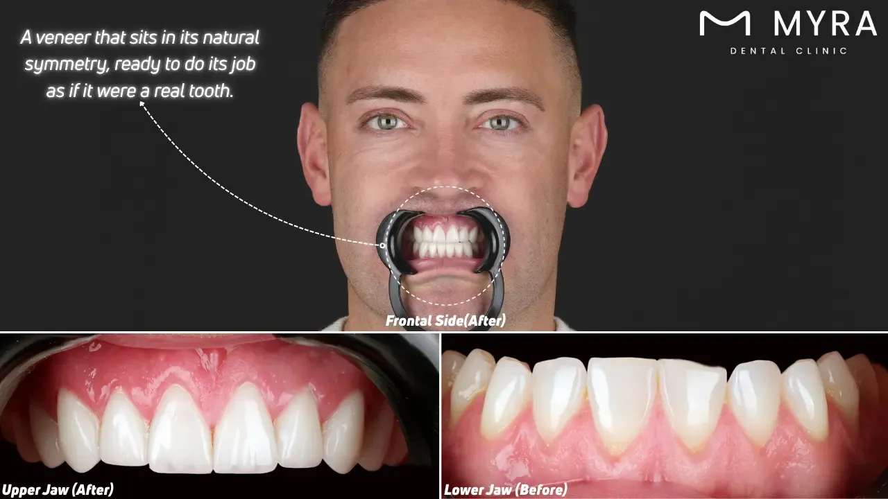 How long do teeth with veneers last