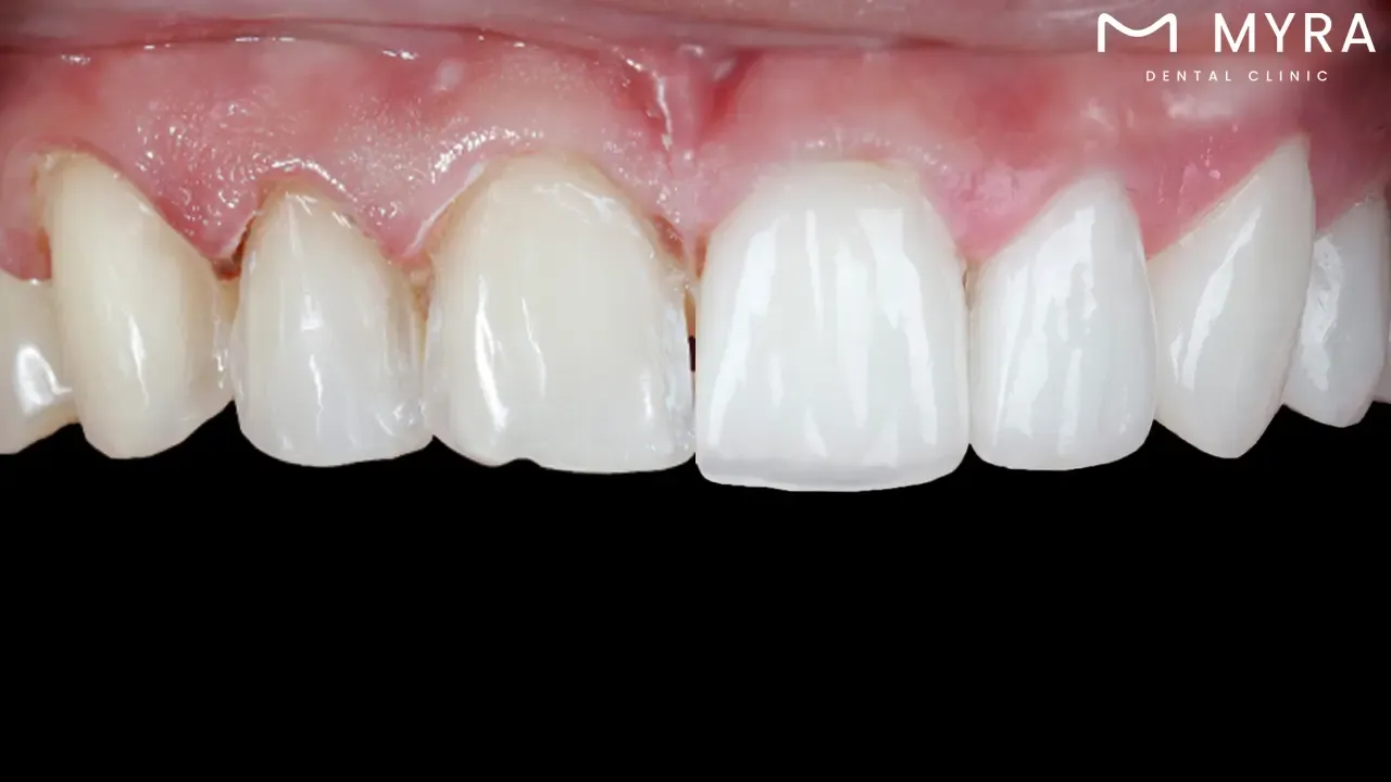 How long do veneers and laminates typically last?